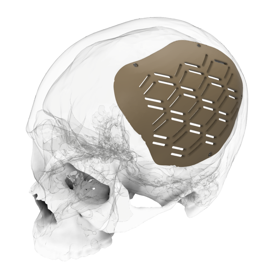 Implante craneal PEEK CRANIUM i3D